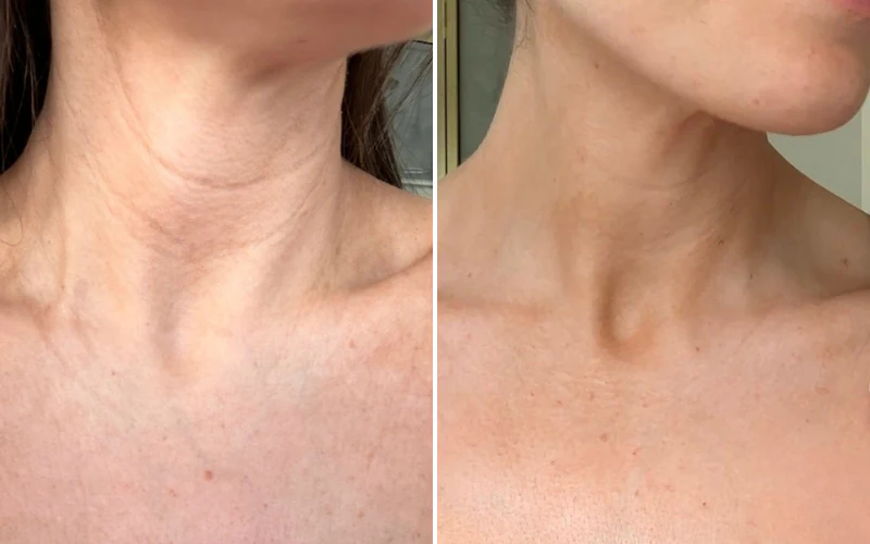 red light therapy for sagging jowls